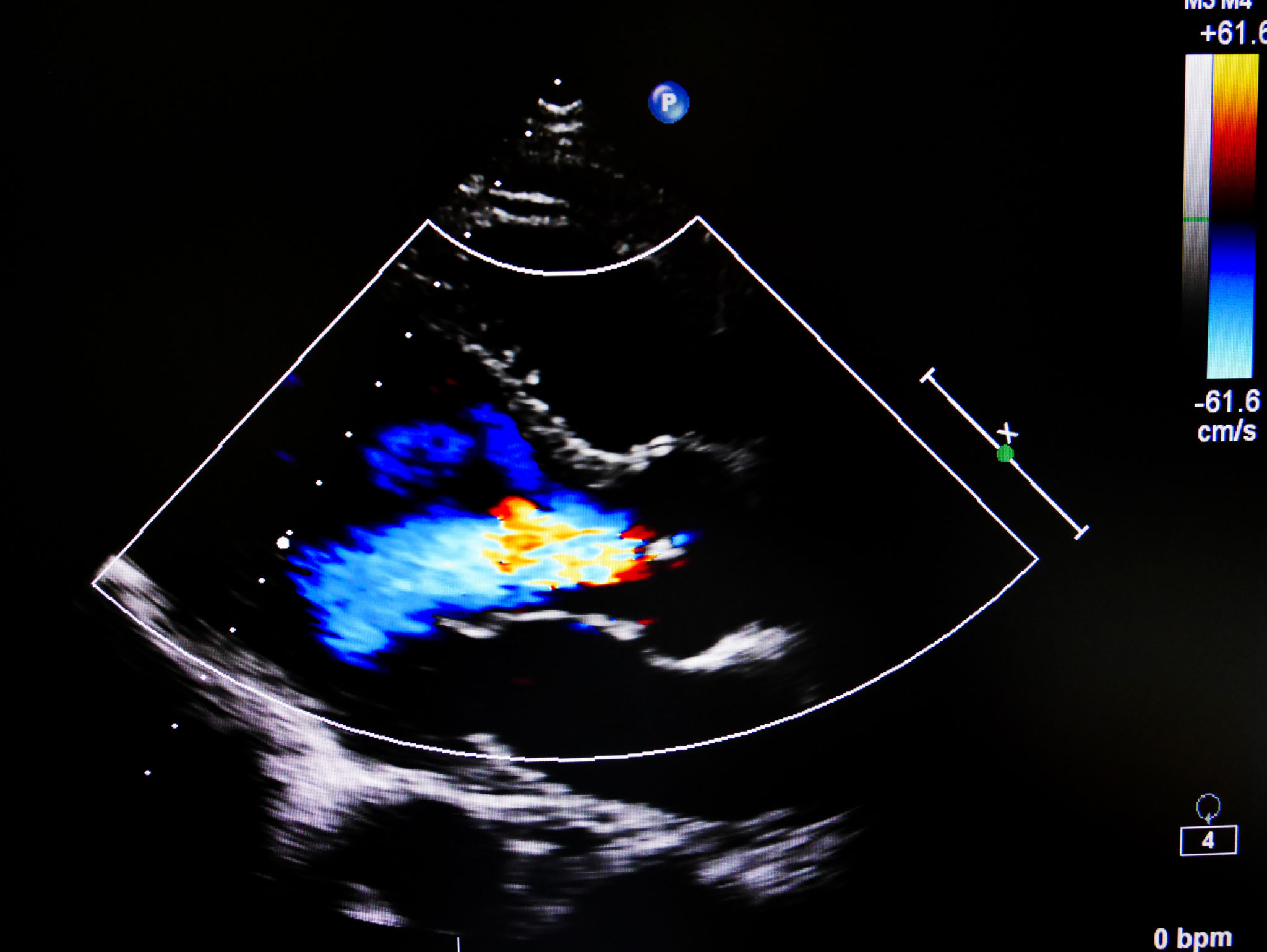 Heart Function Including Ejection Fraction (EF) • MyHeart