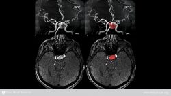 Enfermedad vascular periférica: ¿Qué es?