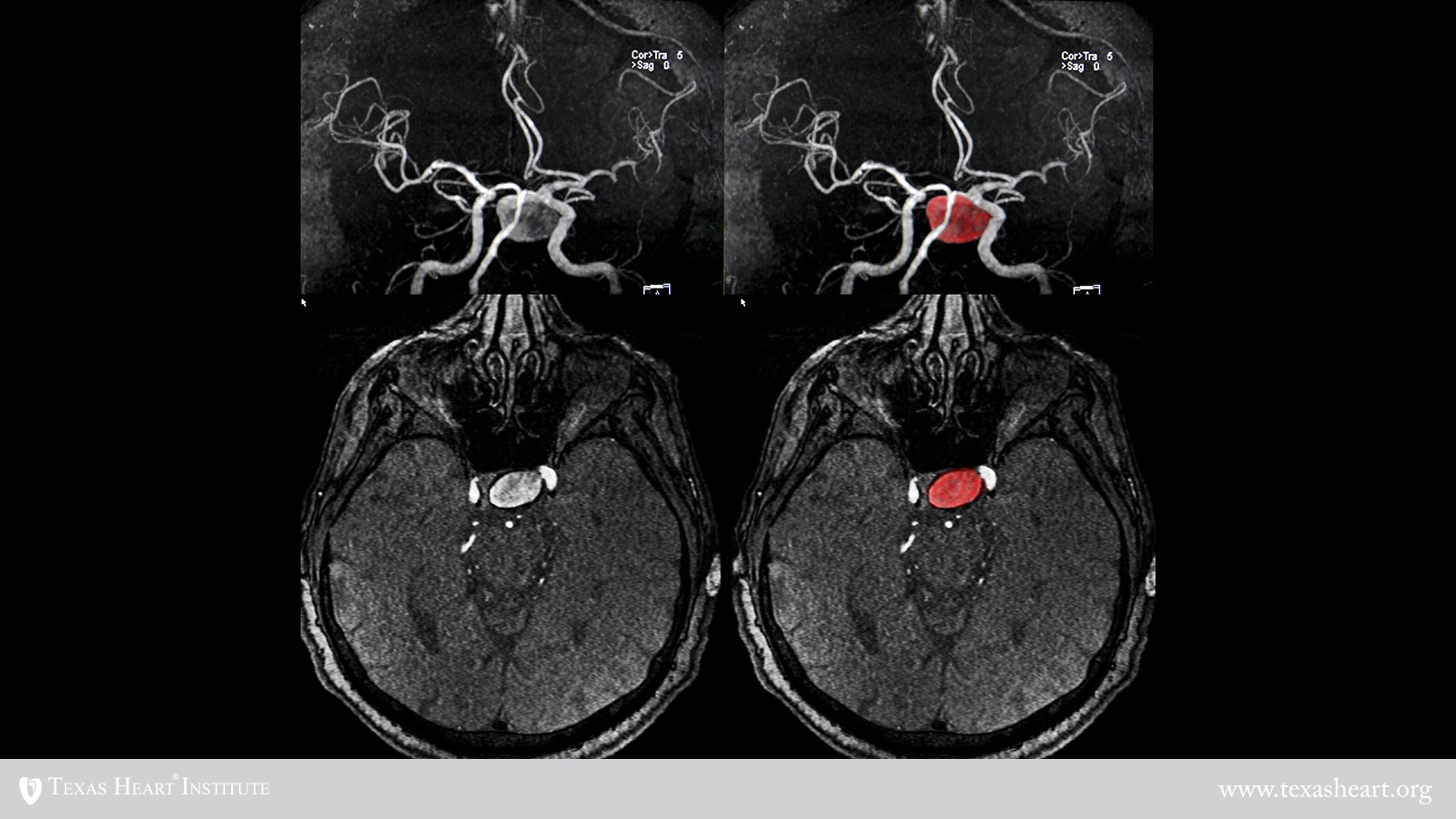 Aneurisma Cerebral Reconhea Os Sintomas E Saiba Como Se Aneurisma Cerebral Reconhea Os Sintomas E Saiba Como Se