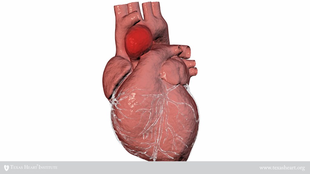 Aneurismas y Disecciones | The Texas Heart Institute®