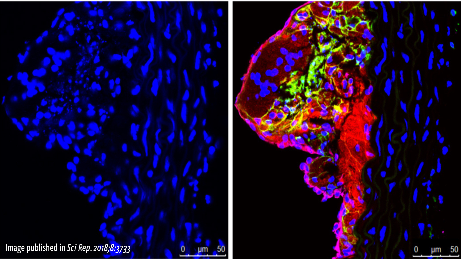 Published in Scientific REPORTS (2018) Magnetic Resonance Imaging of Atherosclerotic Plaque at Clinically Relevant Field Strengths (1T) by Targeting the Integrin α4β1. Woodside DG, Tanifum EA, Ghaghada KB, Biediger RJ, Caivano AR, Starosolski ZA, Khounlo S, Bhayana S, Abbasi S, Craft JW Jr, Maxwell DS, Patel C, Stupin IV, Bakthavatsalam D, Market RV, Willerson JT, Dixon RAF, Vanderslice P, Annapragada AV. Sci Rep. 2018 Feb 27;8(1):3733.