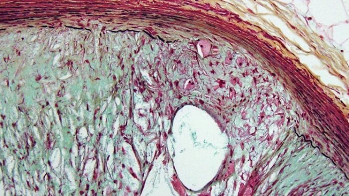 Patología Cardiovascular