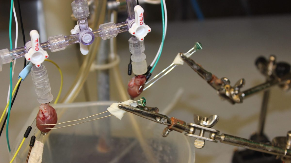 Doctors successfully synchronize both sides of the heart with promising ...