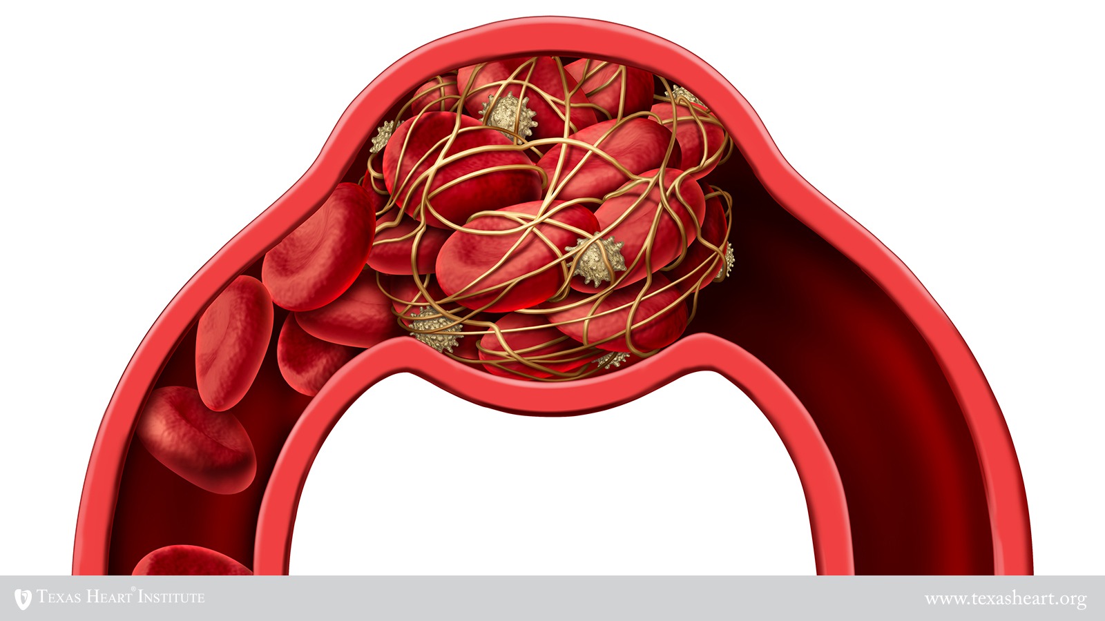 Venous blood clots