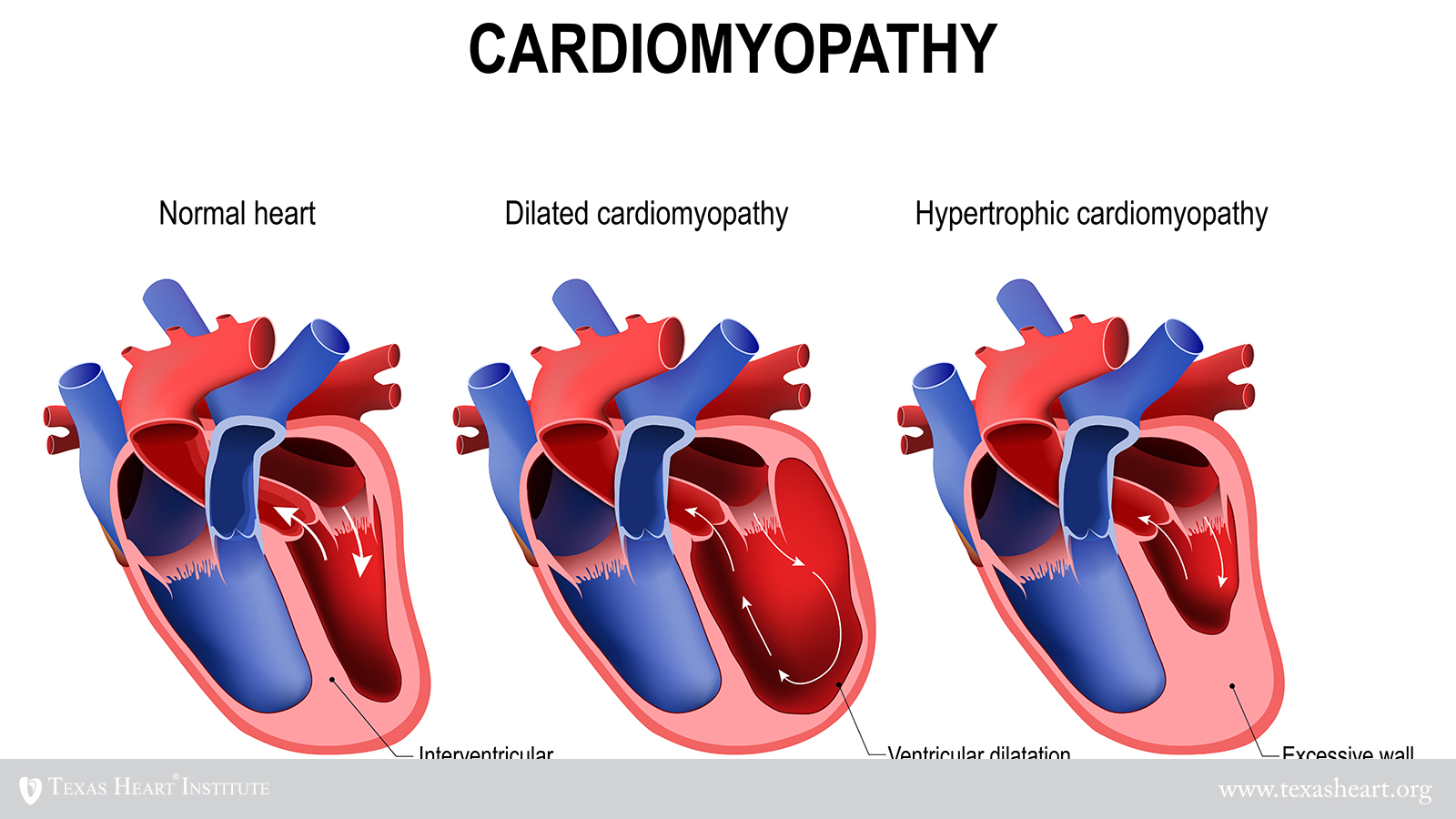 hypertrophy of the heart