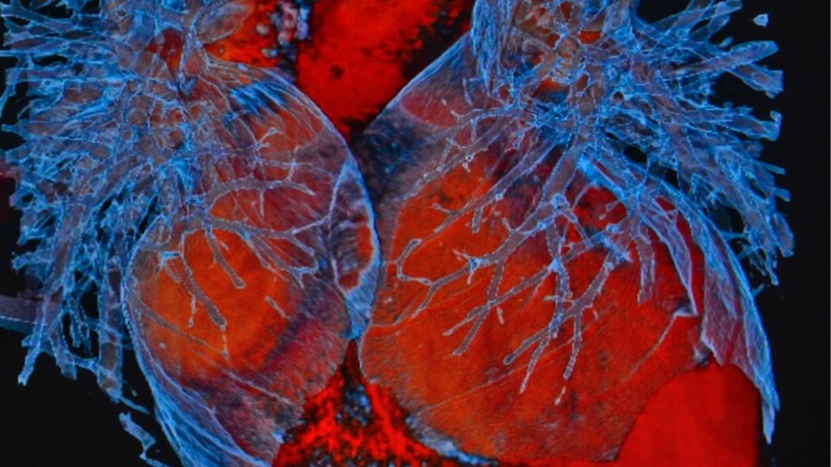 Texas Heart Institute Journal Volume 48, Issue 3 The Texas Heart