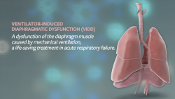 Technology aimed to protect against ventilator-induced diaphragmatic dysfunction (VIDD)