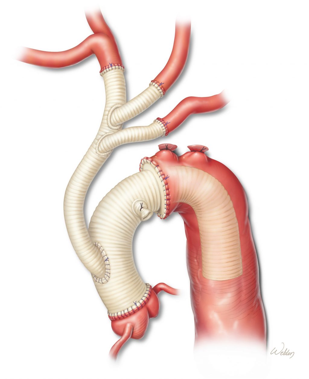 Thirty Years of Experience with the “Elephant Trunk” Technique The