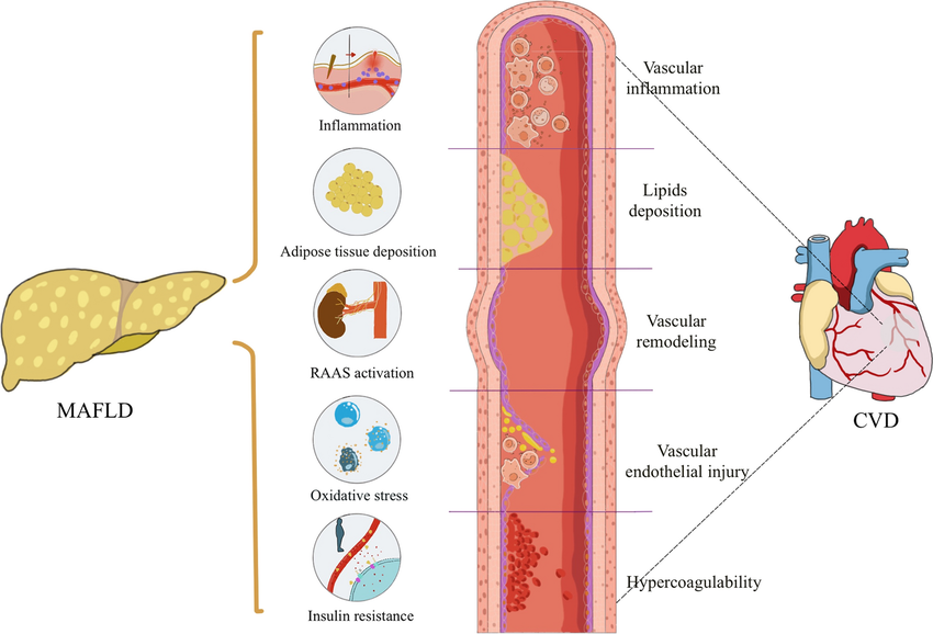 Zhou, Xiao-Dong et al. (2022). Enfermedad del hígado graso asociada a disfunción metabólica e implicaciones para el riesgo cardiovascular y la prevención de enfermedades. Diabetología cardiovascular. 21. 10.1186/s12933-022-01697-0.